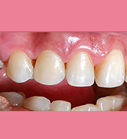 After composite restoration