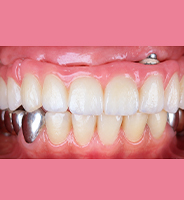 After full mouth rehabilitation