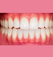 After dental implant treatment
