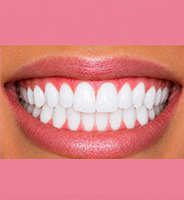 After teeth whitening