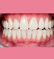 After ultrasonic scaling