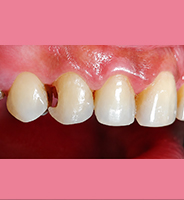 Before composite restoration
