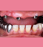 Before full mouth rehabilitation