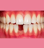 Before dental implant treatment