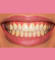 Before teeth whitening
