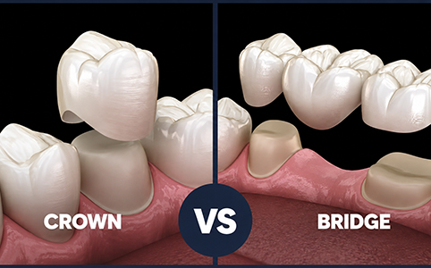 Dental crowns and bridges Kolhapur