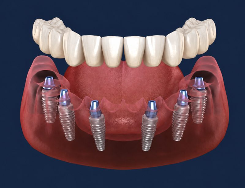 Advanced dental implant equipment at Dr Patil Dr Patole Clinic Kolhapur