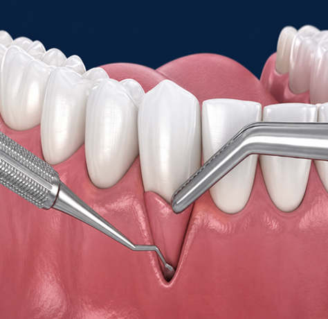 Gum treatment and periodontal therapy in Kolhapur
