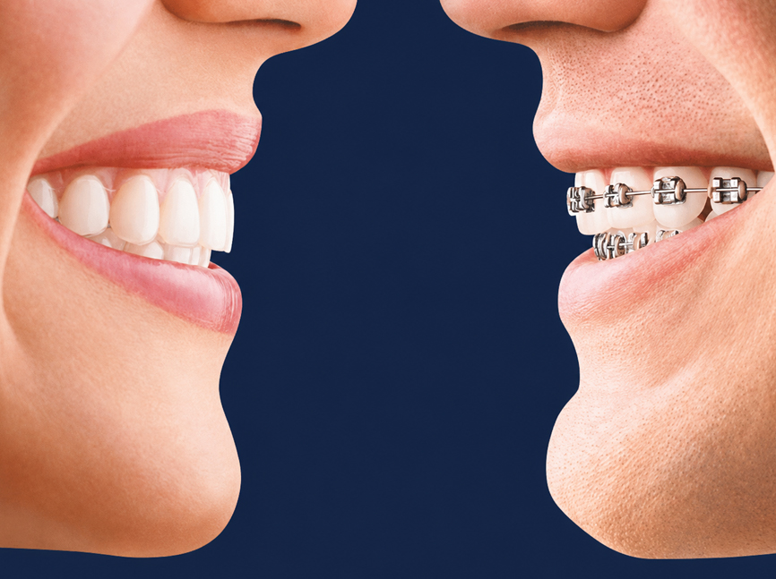 Orthodontic braces Kolhapur