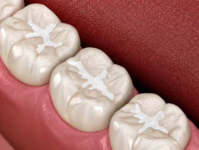 Composite fillings Kolhapur