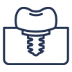 Single Tooth Implant